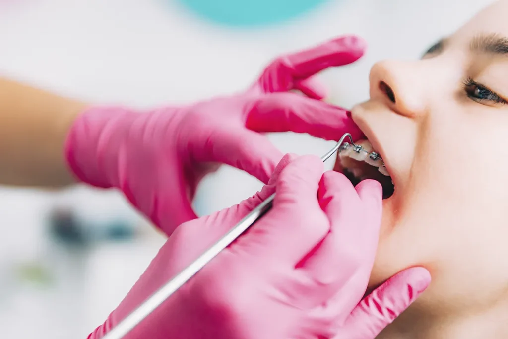Tratamientos de ortodoncia con brackets en Dental Protect, Providencia
