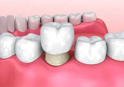 ¿Siempre es necesario poner una corona después de una endodoncia?