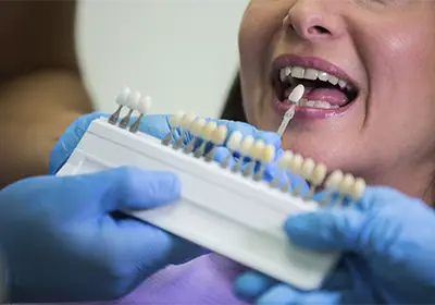 Carillas dentales en Providencia: Cómo transformar la estética de tus dientes en pocas sesiones
