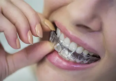 Contenciones dentales: ¿Por qué son esenciales para mantener tu nueva sonrisa?