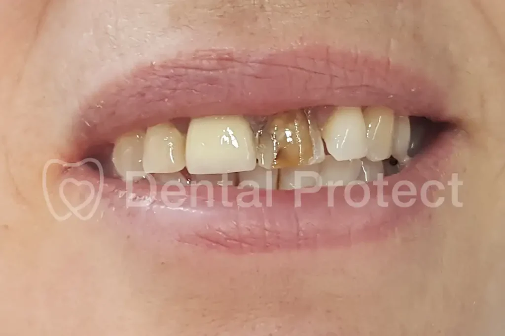 Carillas dentales, caso 1: antes del tratamiento