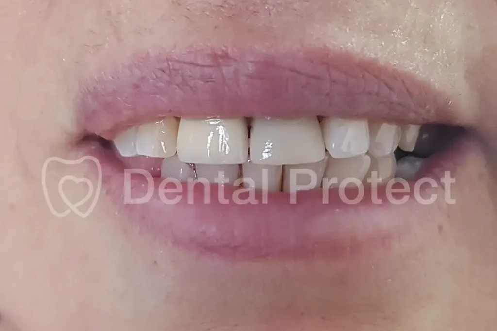 Carillas dentales, caso 1: después del tratamiento