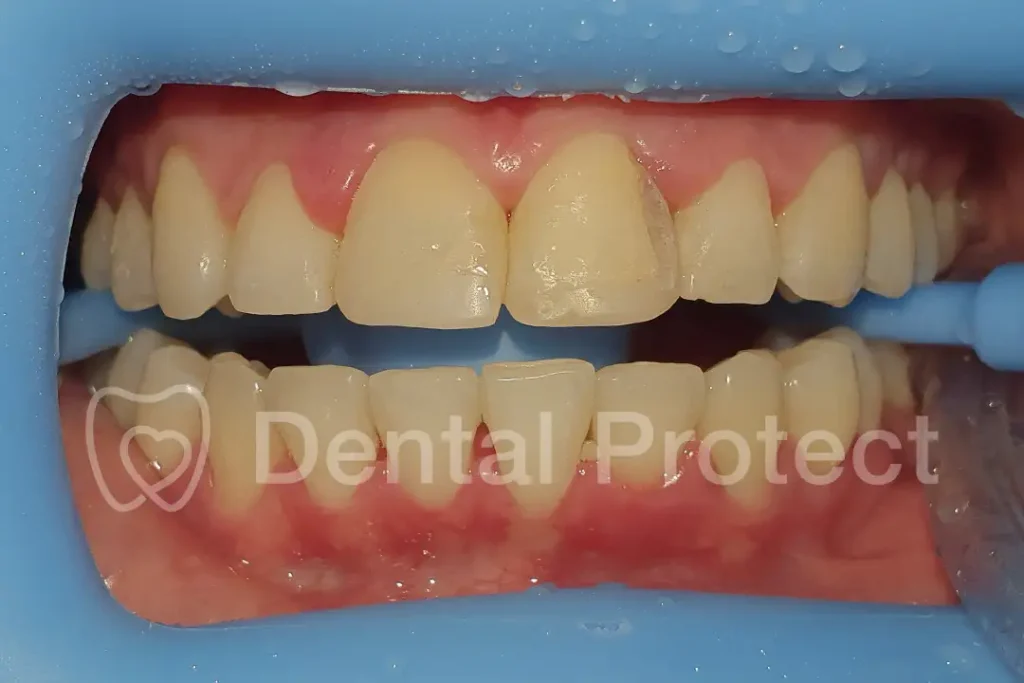Carillas dentales, caso 2: antes del tratamiento
