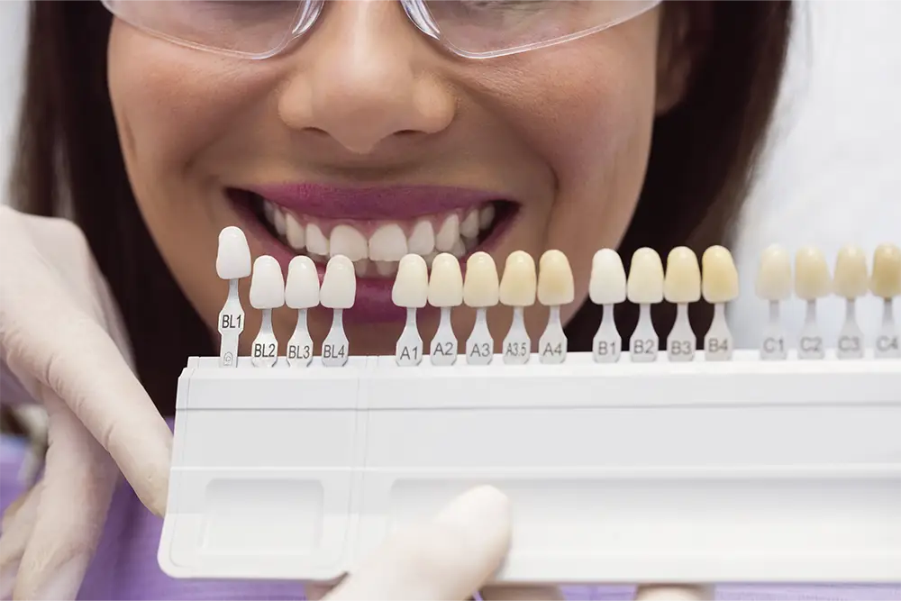 carillas dentales