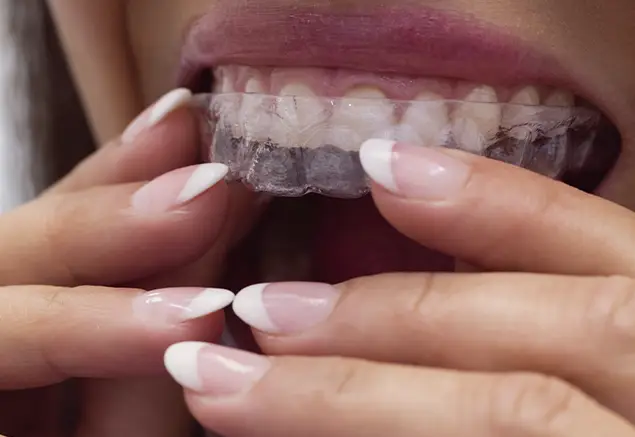 boca con contención dental removible
