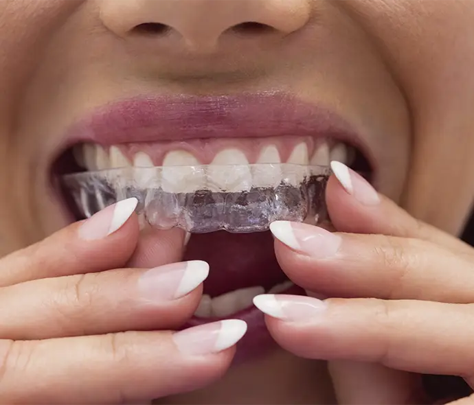 uso de la contención dental