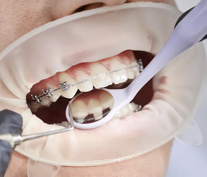 Boca primer plano con brackets metálicos y cerámicos