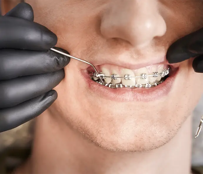 cuánto cuesta ponerse brackets