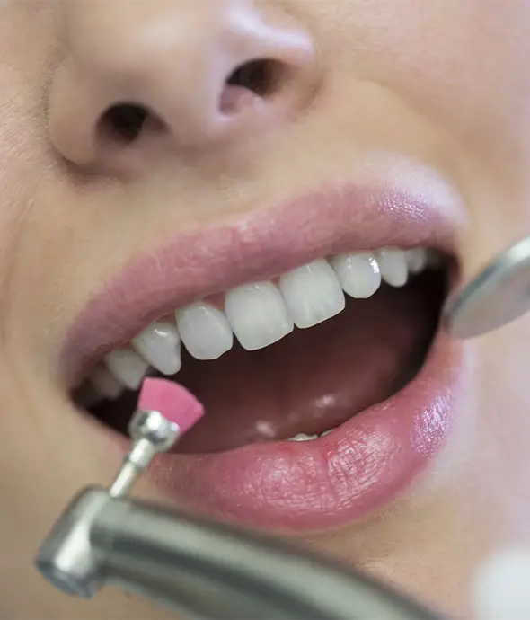 limpieza adhesivo dental